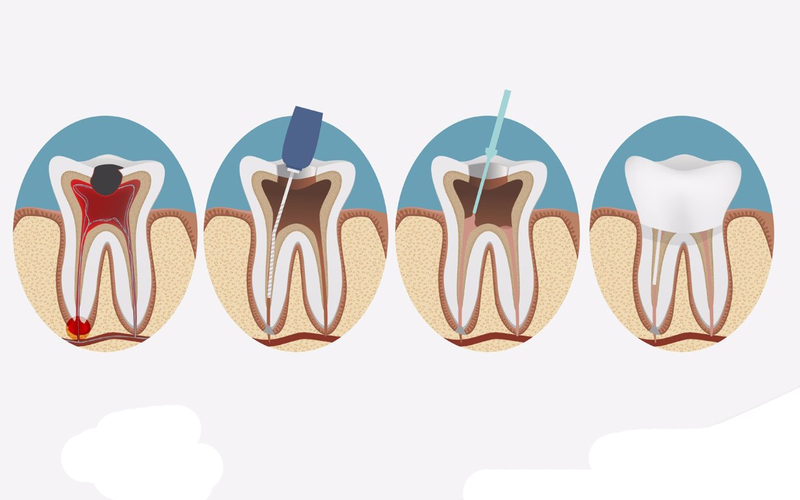 Chữa tủy răng Tìm hiểu quy trình và lợi ích