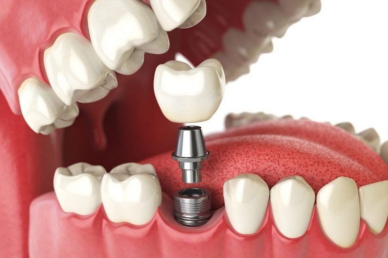 Trồng răng implant