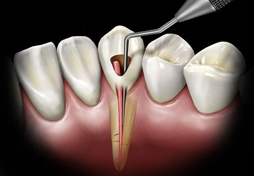 Chữa tủy răng Tìm hiểu quy trình và lợi ích