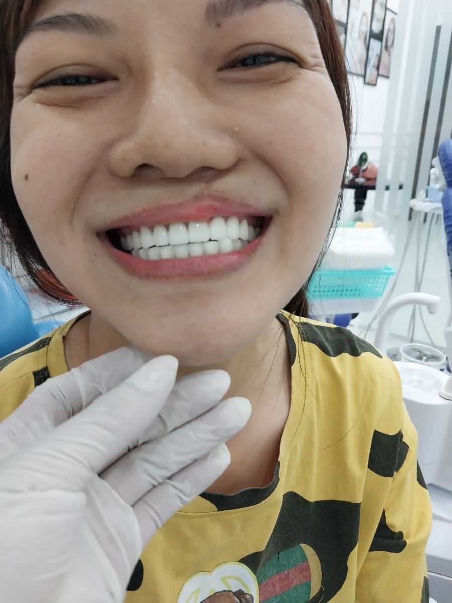 bọc răng sứ tại Biên Hòa