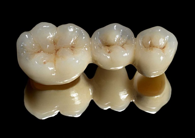 Răng sứ không kim loại Cercon