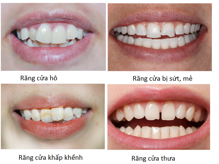 Bọc răng sứ tại nha khoa đại phước