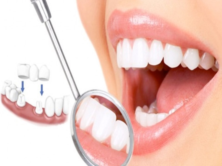 bọc răng sứ tại Biên Hòa