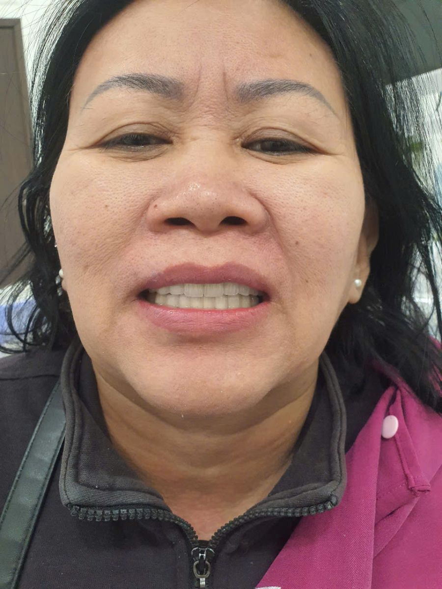 Bọc răng sứ 2