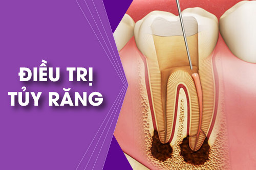 Chữa tủy răng Tìm hiểu quy trình và lợi ích