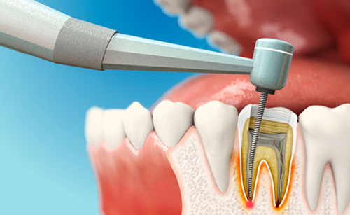 Chữa tủy răng Tìm hiểu quy trình và lợi ích